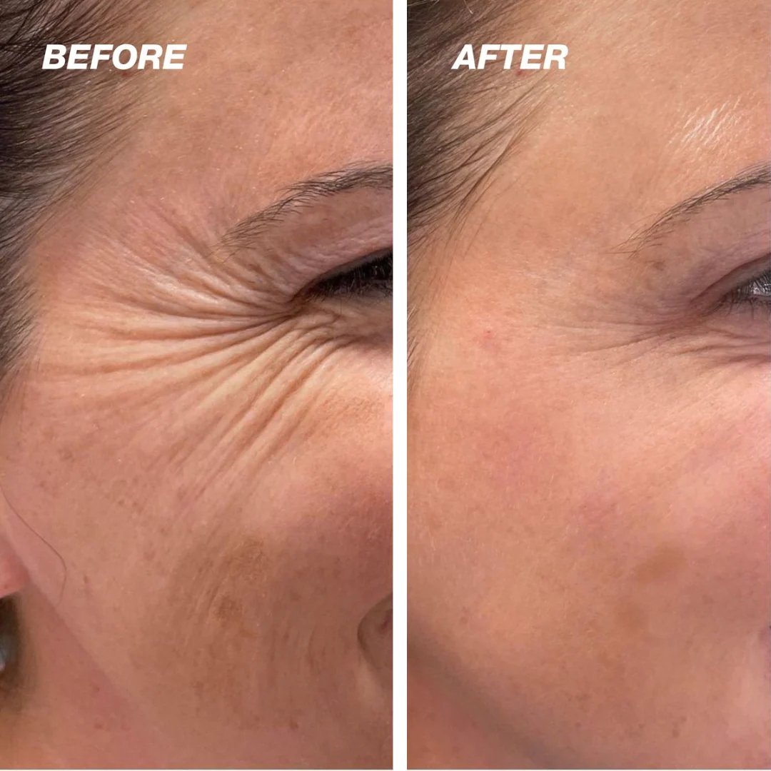Rovinao™ The Vita A Retinal Shot Tightening Booster